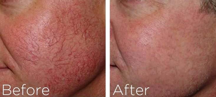 http://gaughfdermatology.com/wp-content/uploads/2015/12/versapulse-for-facial-veins.jpg